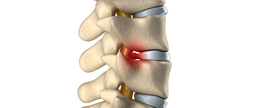 6 Tips for Relieving Pain From Herniated Discs | Craven SPORT Services
